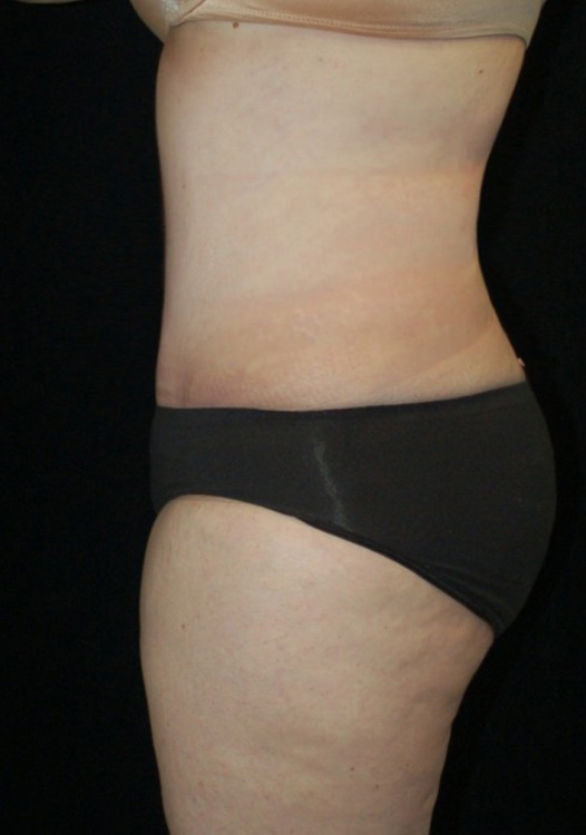 After thumbnail for Case 8 Tummy Tuck Before and After Photos