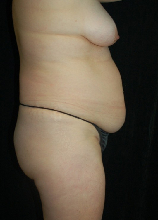 Before thumbnail for Case 12 Tummy Tuck Before and After Photos