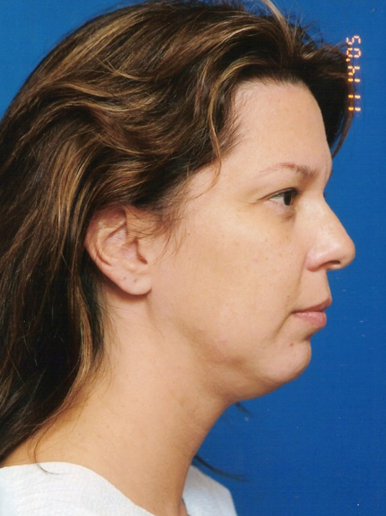 Before thumbnail for Case 9 Chin Augmentation Before and After Photos