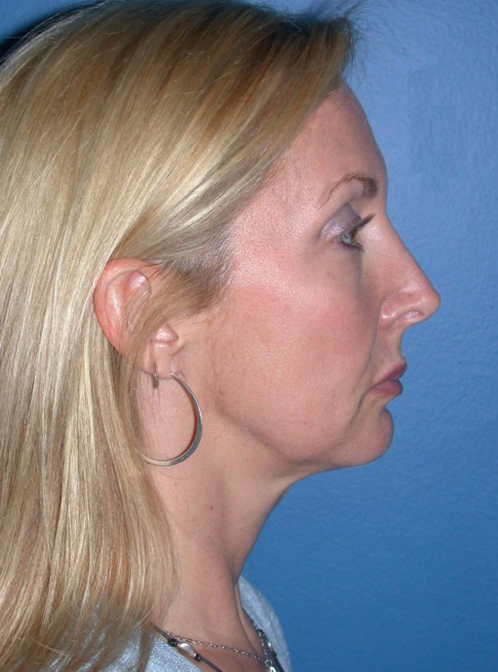 Before thumbnail for Case 1 Facelift Before and After Photos