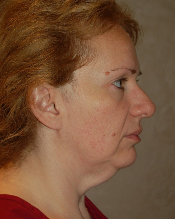 Before thumbnail for Case 2 Facelift Before and After Photos