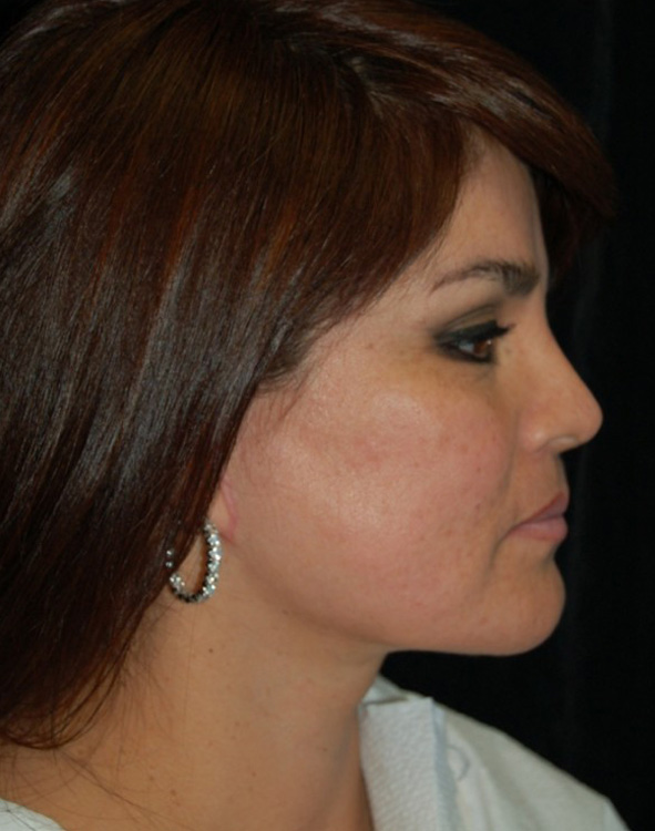 After thumbnail for Case 4 Facelift Before and After Photos