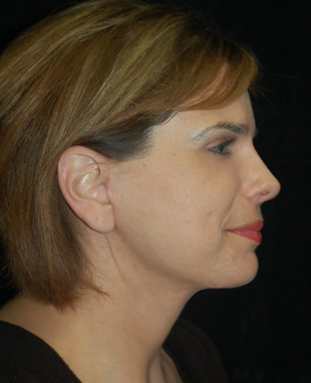 After thumbnail for Case 7 Facelift Before and After Photos
