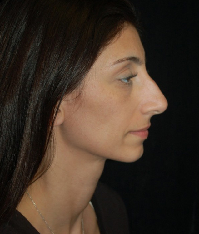 Before thumbnail for Case 19 Facial Fat Grafting Before and After Photos