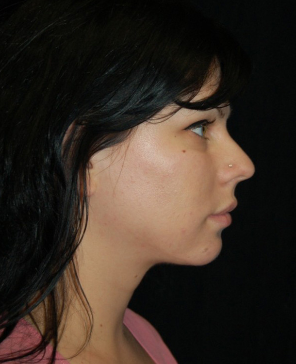 After thumbnail for Case 2 Neck Liposuction Before and After Photos