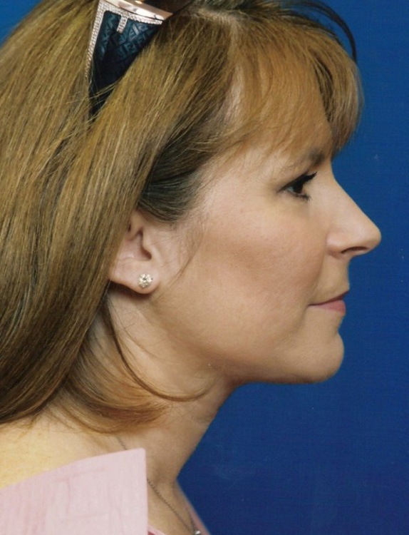 After thumbnail for Case 7 Neck Liposuction Before and After Photos