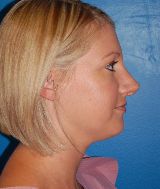 Before thumbnail for Case 13 Neck Liposuction Before and After Photos
