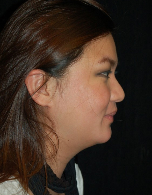Before thumbnail for Case 15 Neck Liposuction Before and After Photos