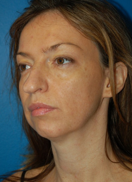Before thumbnail for Case 1 Profile Balancing (Chin & Rhinoplasty) Before and After Photos