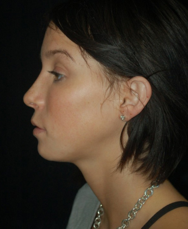 After thumbnail for Case 8 Profile Balancing (Chin & Rhinoplasty) Before and After Photos
