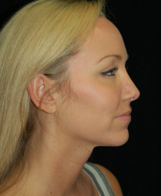 After thumbnail for Case 9 Profile Balancing (Chin & Rhinoplasty) Before and After Photos