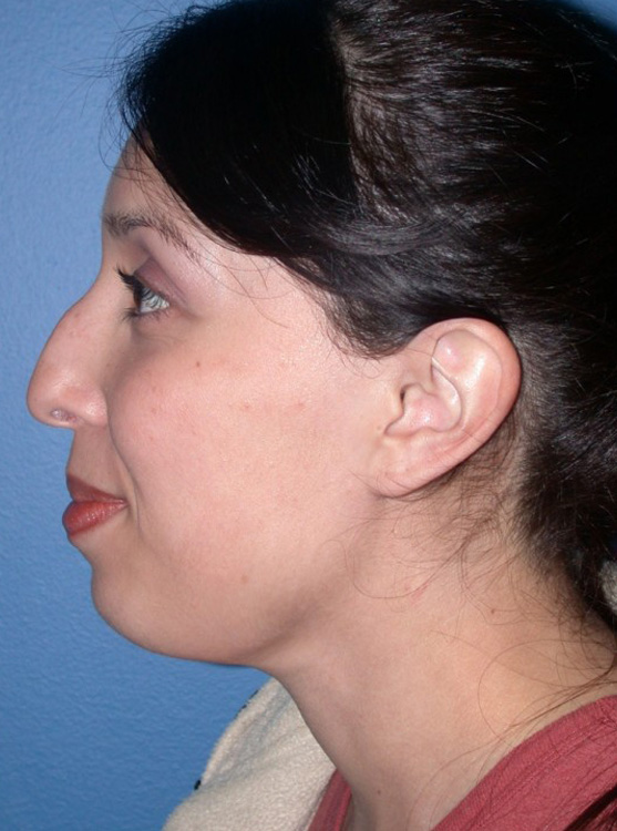 Before thumbnail for Case 2 Rhinoplasty Before and After Photos