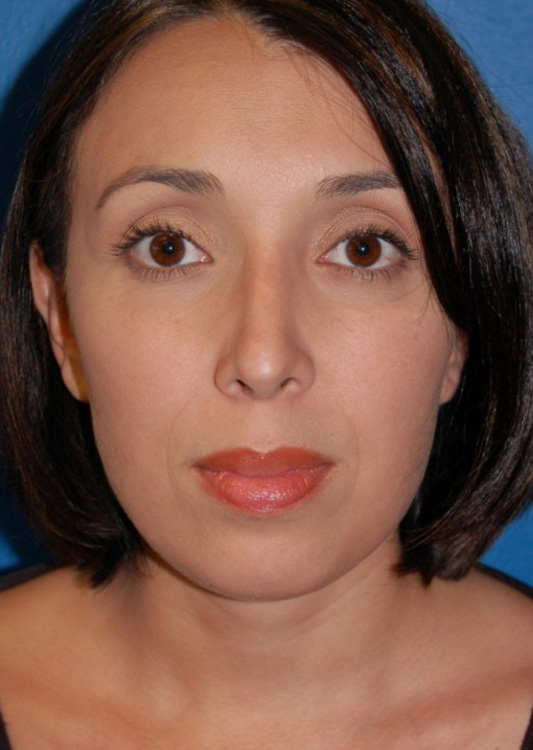 After thumbnail for Case 2 Rhinoplasty Before and After Photos
