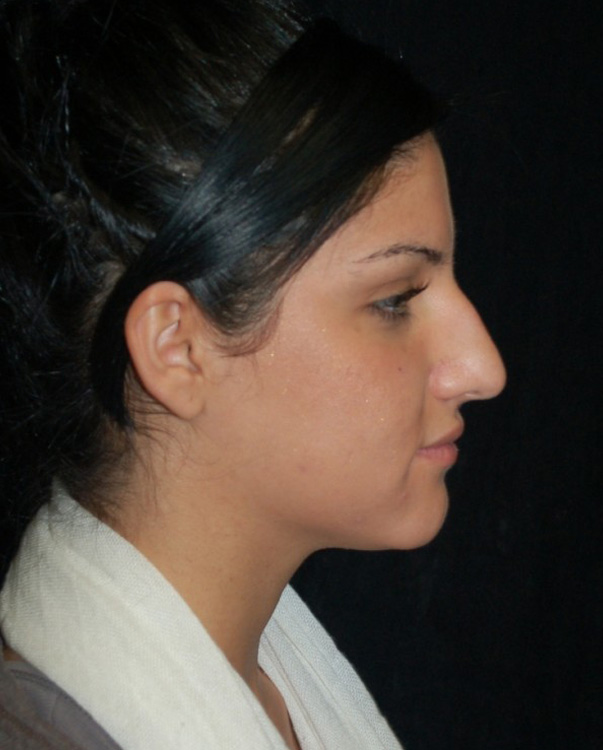 Before thumbnail for Case 3 Rhinoplasty Before and After Photos