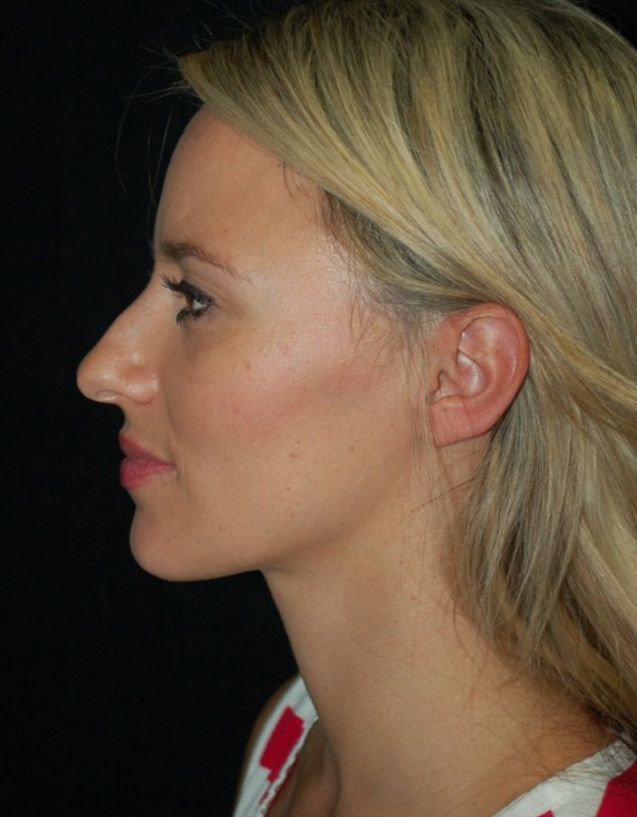 Before thumbnail for Case 4 Rhinoplasty Before and After Photos