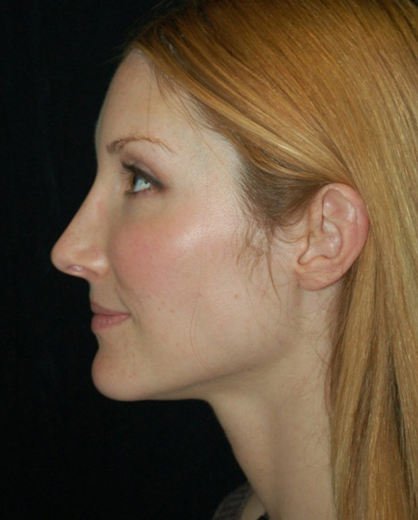 After thumbnail for Case 5 Rhinoplasty Before and After Photos