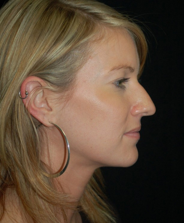 Before thumbnail for Case 8 Rhinoplasty Before and After Photos