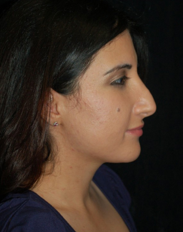 Before thumbnail for Case 9 Rhinoplasty Before and After Photos