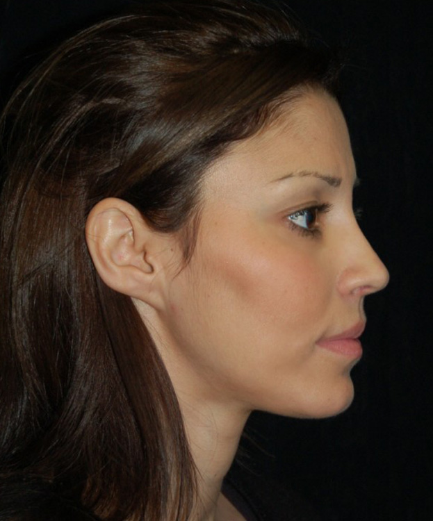 After thumbnail for Case 13 Rhinoplasty Before and After Photos