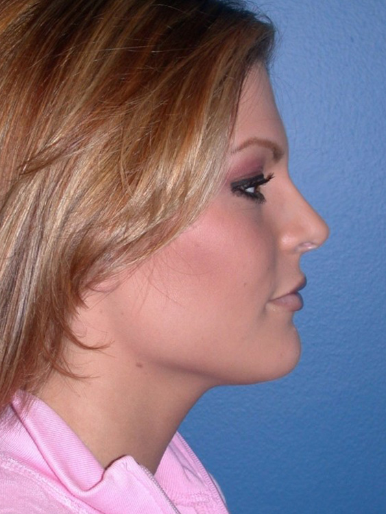 After thumbnail for Case 12 Rhinoplasty Before and After Photos