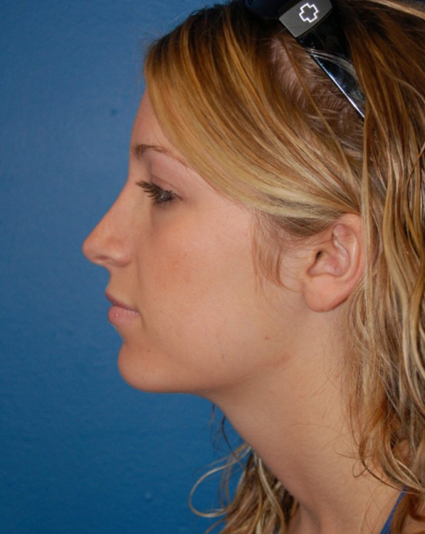 After thumbnail for Case 15 Rhinoplasty Before and After Photos