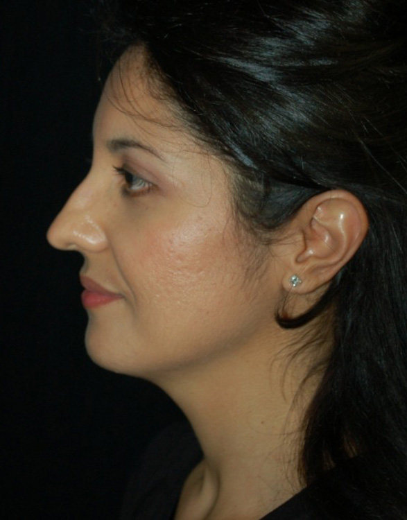 Before thumbnail for Case 19 Rhinoplasty Before and After Photos