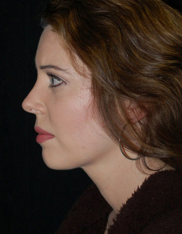 After thumbnail for Case 20 Rhinoplasty Before and After Photos