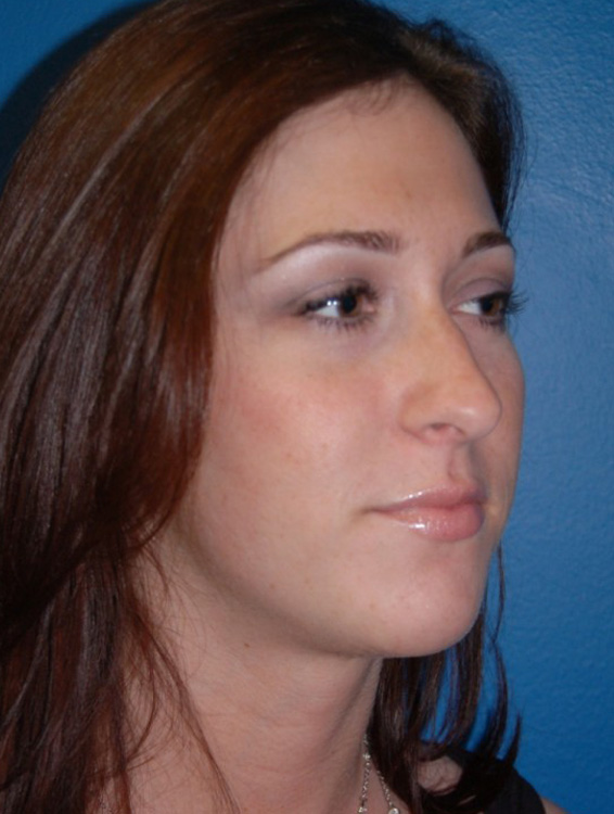 Before thumbnail for Case 25 Rhinoplasty Before and After Photos