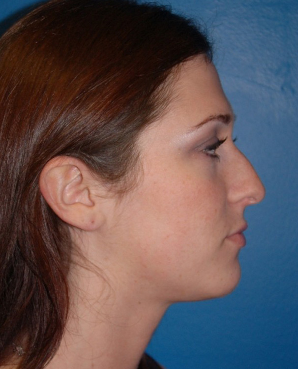 Before thumbnail for Case 25 Rhinoplasty Before and After Photos