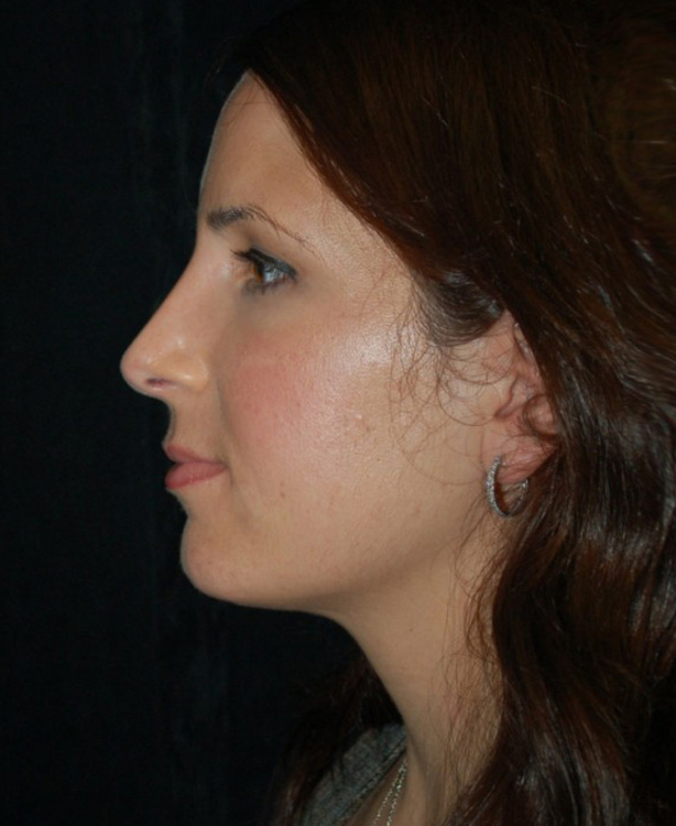 After thumbnail for Case 29 Rhinoplasty Before and After Photos