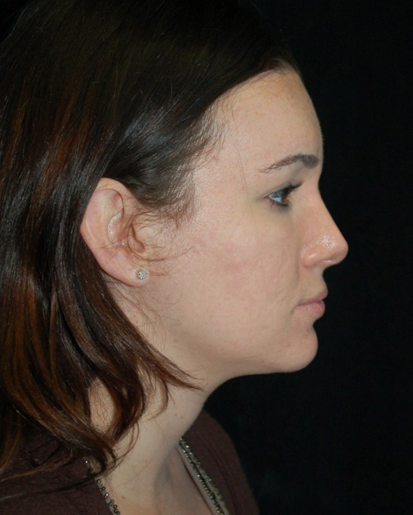 After thumbnail for Case 32 Rhinoplasty Before and After Photos