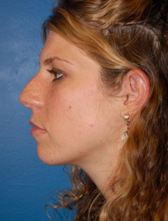 Before thumbnail for Case 34 Rhinoplasty Before and After Photos