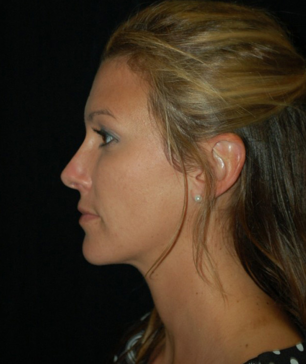 After thumbnail for Case 35 Rhinoplasty Before and After Photos
