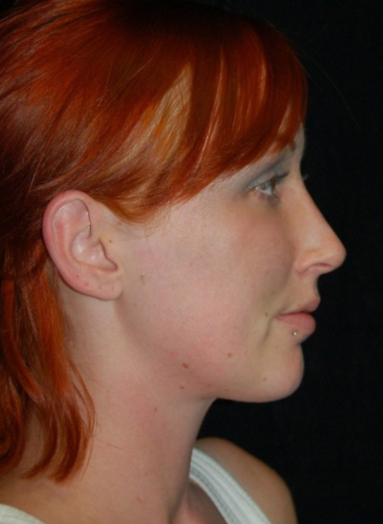 After thumbnail for Case 39 Rhinoplasty Before and After Photos