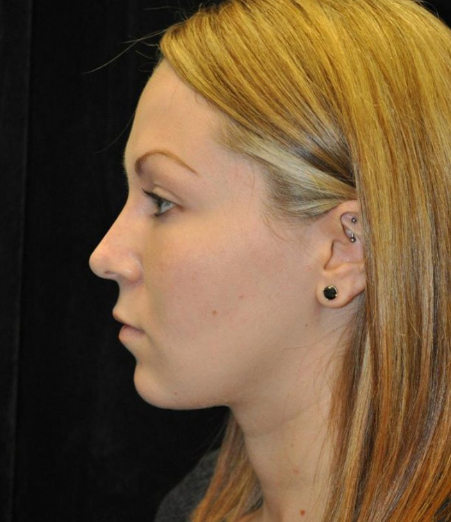 After thumbnail for Case 41 Rhinoplasty Before and After Photos