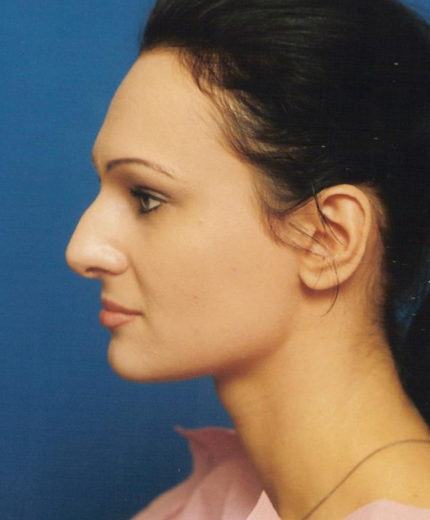 Before thumbnail for Case 42 Rhinoplasty Before and After Photos