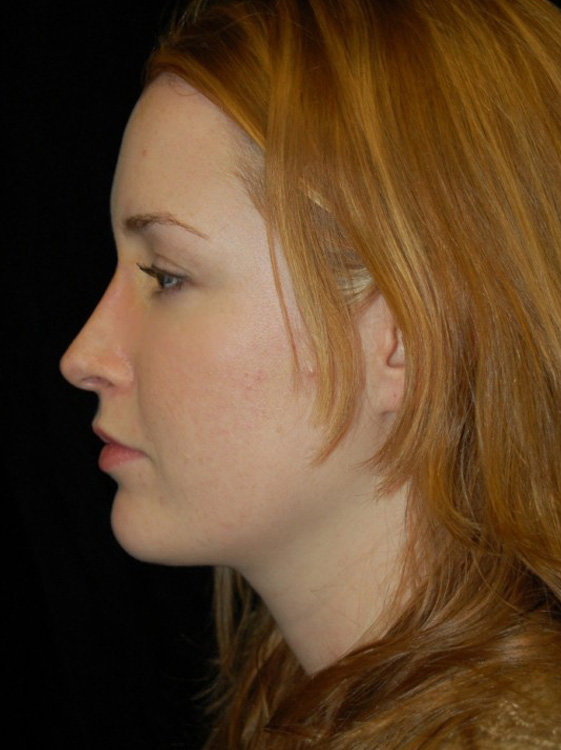 After thumbnail for Case 47 Rhinoplasty Before and After Photos