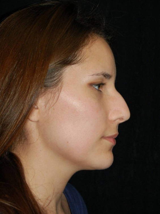 Before thumbnail for Case 51 Rhinoplasty Before and After Photos