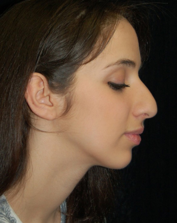 Before thumbnail for Case 54 Rhinoplasty Before and After Photos
