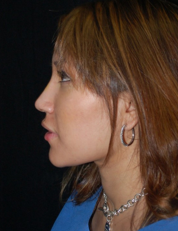 After thumbnail for Case 59 Rhinoplasty Before and After Photos