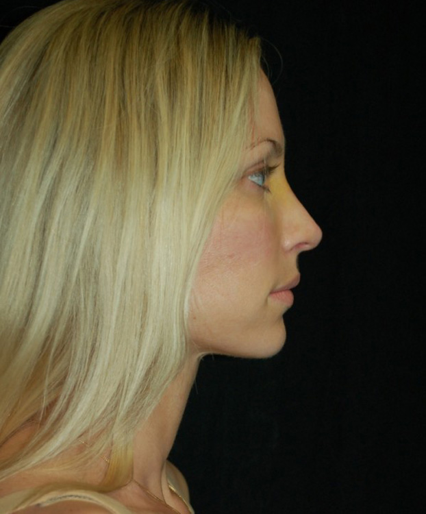 After thumbnail for Case 62 Rhinoplasty Before and After Photos