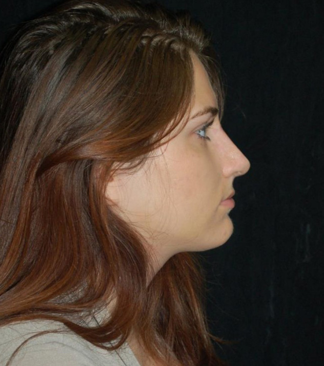 After thumbnail for Case 67 Rhinoplasty Before and After Photos