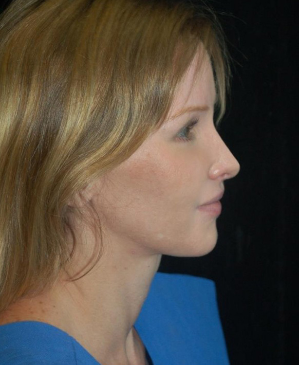 After thumbnail for Case 68 Rhinoplasty Before and After Photos