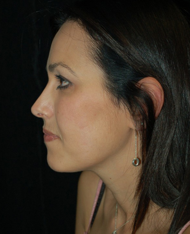 After thumbnail for Case 71 Rhinoplasty Before and After Photos