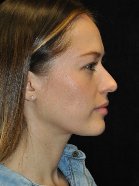 Before thumbnail for Case 77 Rhinoplasty Before and After Photos