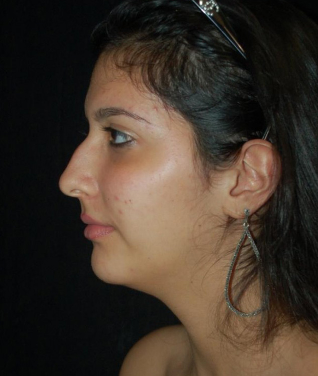 Before thumbnail for Case 78 Rhinoplasty Before and After Photos