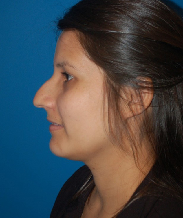 Before thumbnail for Case 81 Rhinoplasty Before and After Photos