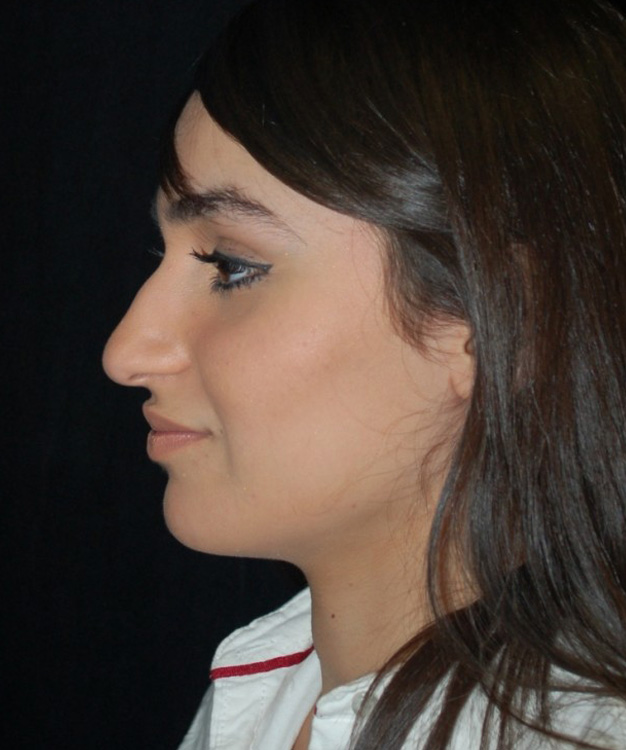 Before thumbnail for Case 86 Rhinoplasty Before and After Photos