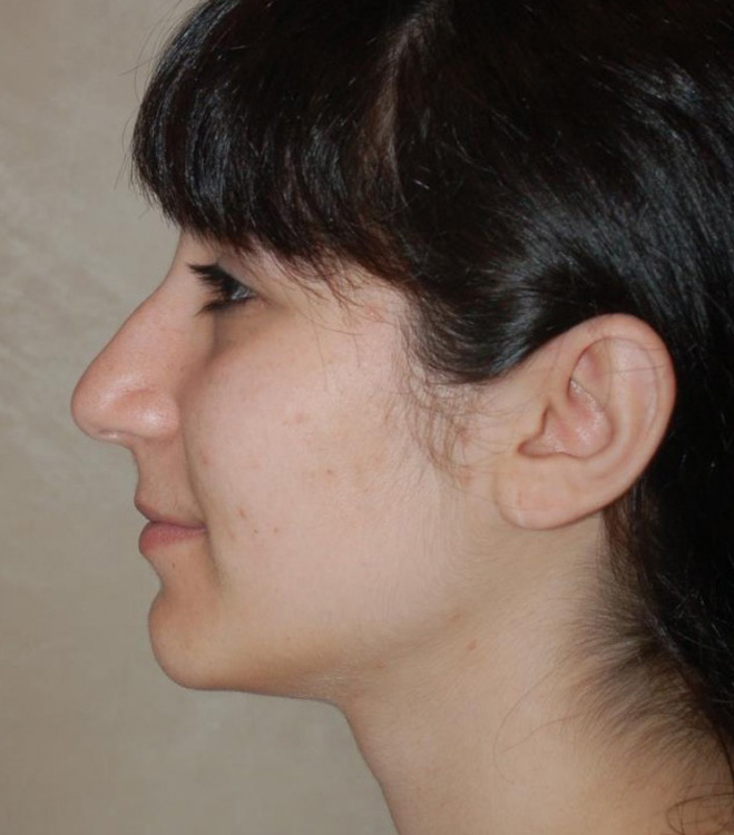 Before thumbnail for Case 88 Rhinoplasty Before and After Photos
