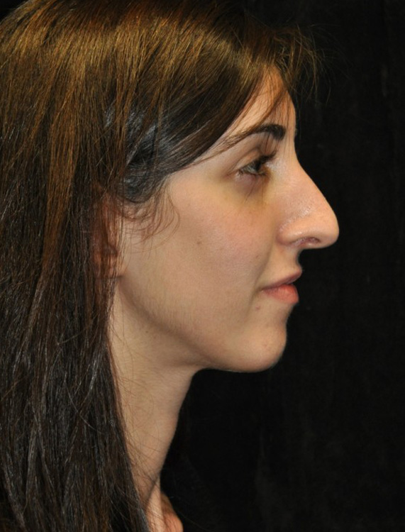 Before thumbnail for Case 93 Rhinoplasty Before and After Photos